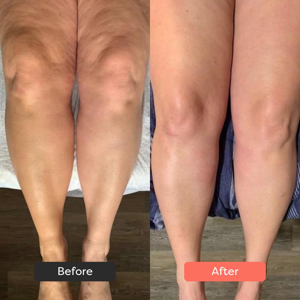 LÚMORA's Body Sculpting Device