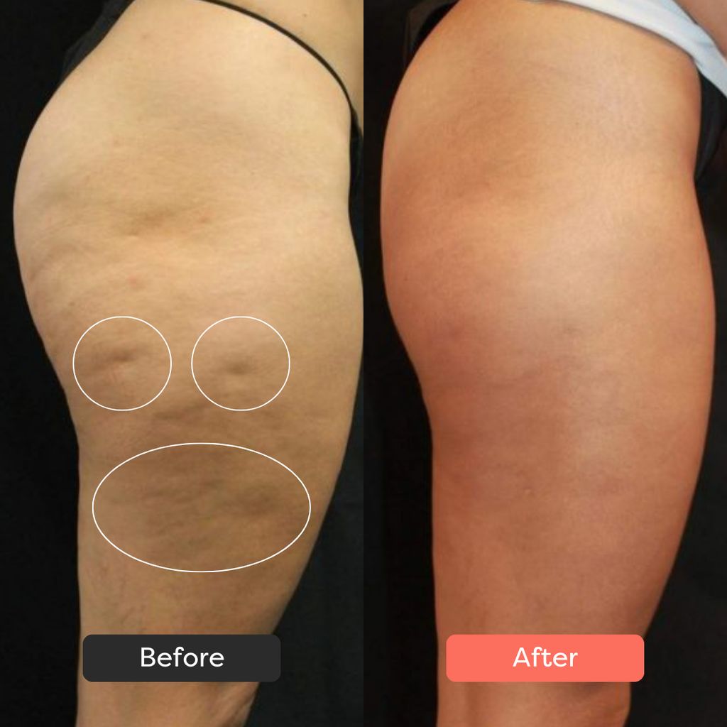 LÚMORA's Body Sculpting Device