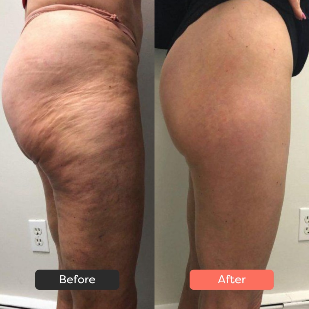 LÚMORA's Body Sculpting Device